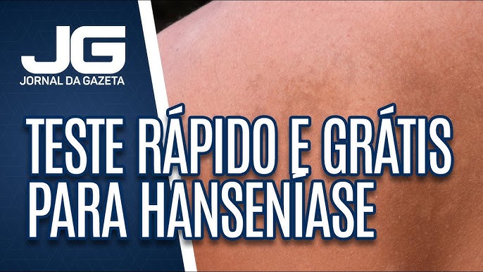 Hanseníase: conheça os sintomas e o tratamento para a doença – Jornal  Semanário