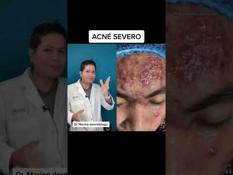 Vídeo: He de veure un dermatòleg per pigmentació?