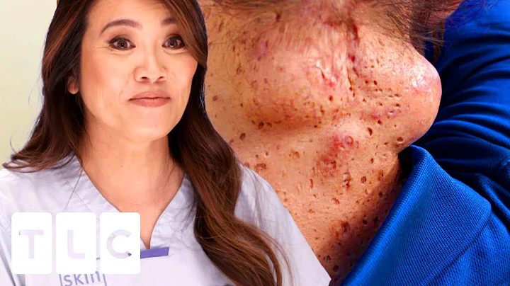 CYST-ception: A Cyst INSIDE A Cyst (SQUIRT-ALERT!) | Dr. Pimple Popper - DayDayNews