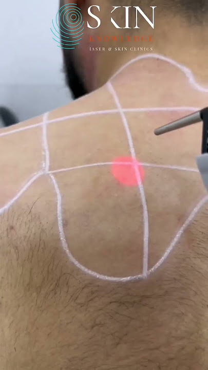 Laser Hair Removal for Men