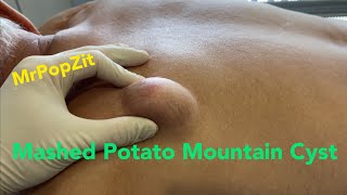 Mashed Potato Mountain Cyst. Giant cyst popped with sac dissection. Must see. MrPopZit.