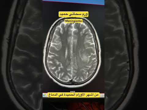 ورم سحائي حميد 