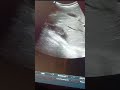 #ultrasound #youtubeshorts