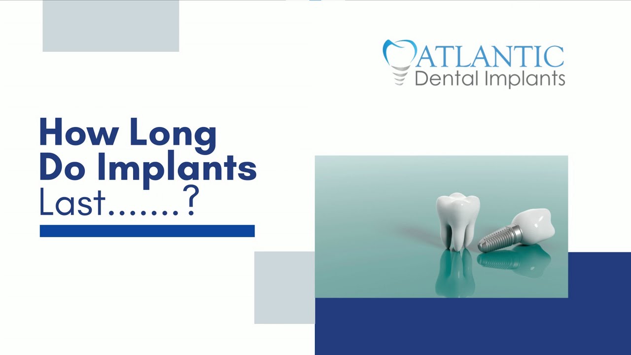 How Long Do Implants Last? 🦷 Atlantic Dental Group YouTube