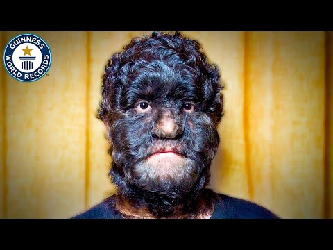 The World's Hairiest Family - Guinness World Records