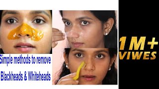 Simple & Effective method to remove Black Heads and White heads || Beyoudefining screenshot 5