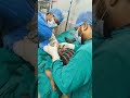 #doctor .Illazaro operation shortening leg