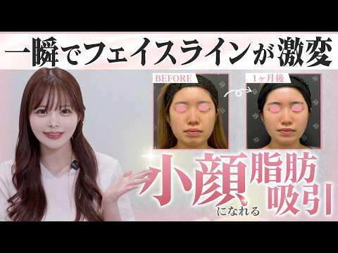 【症例紹介】垢抜け！簡単に小顔になれる「LSSA脂肪吸引」施術をご紹介🎀✨【まいか先生 垢抜け 美容外科】