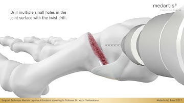APTUS Foot Hallux System 2.8 Lapidus Arthrodese TMT-1 Medial Fusion