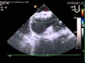 Ultrasept ASD Device Echo Post Release
