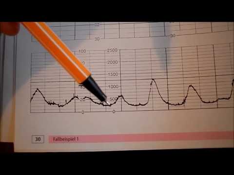 Video: Cara Menguraikan CTG Janin