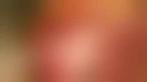 TEMPORAL FOSSA FASCIA MUSCLE PTERION EDH BURR HOLE – Sanjoy Sanyal – Proceum