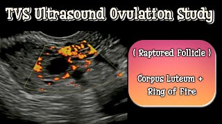 TVS Ultrasound Follicular monitoring | Raptured Follilce - Ovulation Study