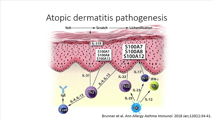 Autoimmune Comorbidities