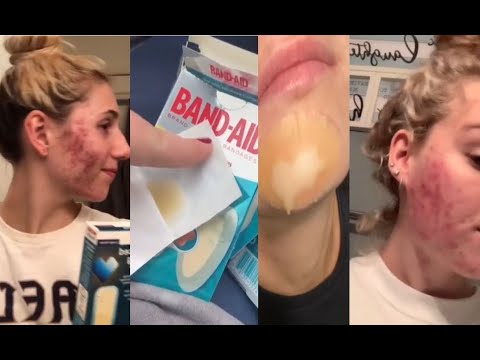 Hydrocolloid Hydroseal Patch TikTok Compilation: Does it Work?!