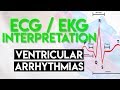 Ventricular Arrhythmias Quiz