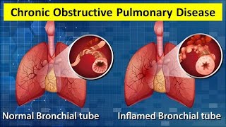 Chronic Obstructive Pulmonary Disease | UPSC CSE | #upsc #currentaffairs #gk