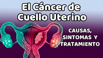 ¿En qué parte del cuello uterino se desarrollan la mayoría de los cánceres?