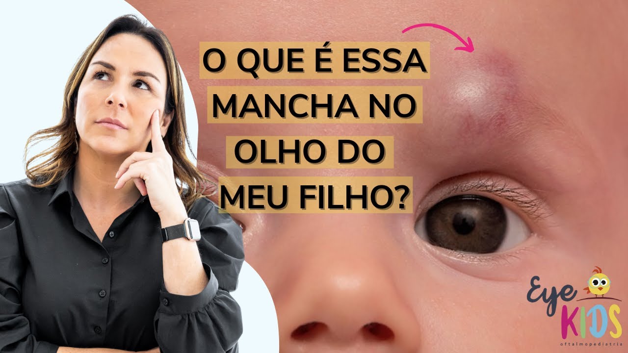HEMANGIOMA CAPILAR | O QUE É ESSA MANCHA VERMELHA NO OLHO DO MEU FILHO ...