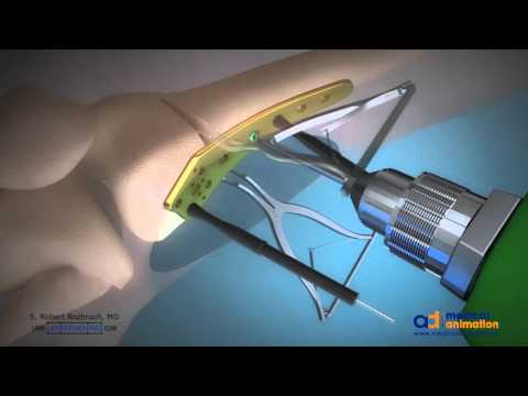 Distal Femoral Osteotomy Animation