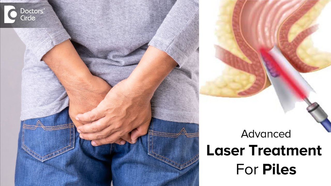 Advanced Laser Treatment For Piles | LASER Procedure MYTH BUSTED-Dr.  Rajasekhar MR | Doctors' Circle - YouTube