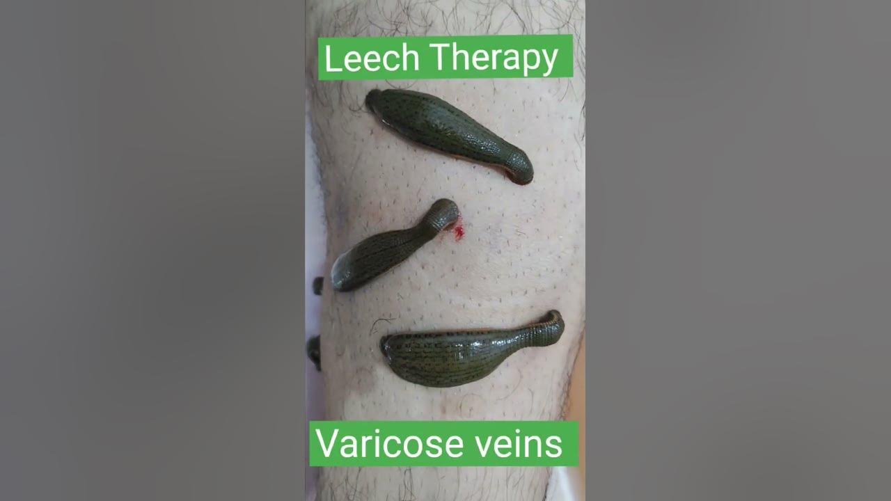 Varicose Veins : Leech Therapy is the solution #varicosevein # ...