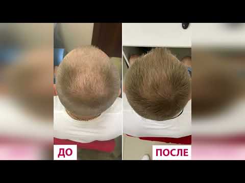 Результаты лечения волос