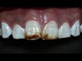 Tratamiento fluorosis dental  antivet