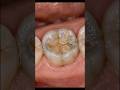 Severely Worn Tooth Rebuilt Like New! 🦷 Extreme Bruxism Repair #shorts