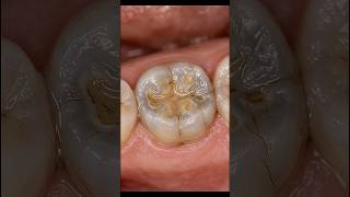 Severely Worn Tooth Rebuilt Like New! 🦷 Extreme Bruxism Repair #shorts