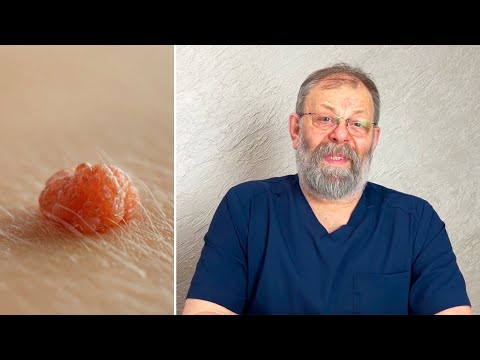 Video: Kunne du ha humant papillomavirus?