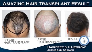 BIO-FUE Hair Transplant | Best Hair Transplant Clinic In Gurugram | Hairfree & Hairgrow Clinic India