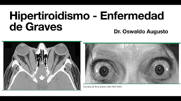 ¿Cuál es la diferencia entre la enfermedad de Graves y el hipertiroidismo?