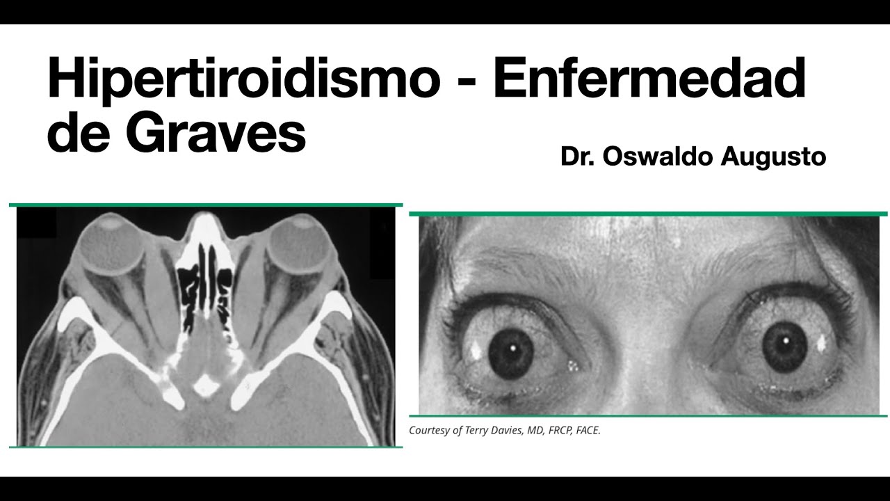 hipertiroidismo-enfermedad-de-graves-n-dulo-t-xico-endocrinolog-a