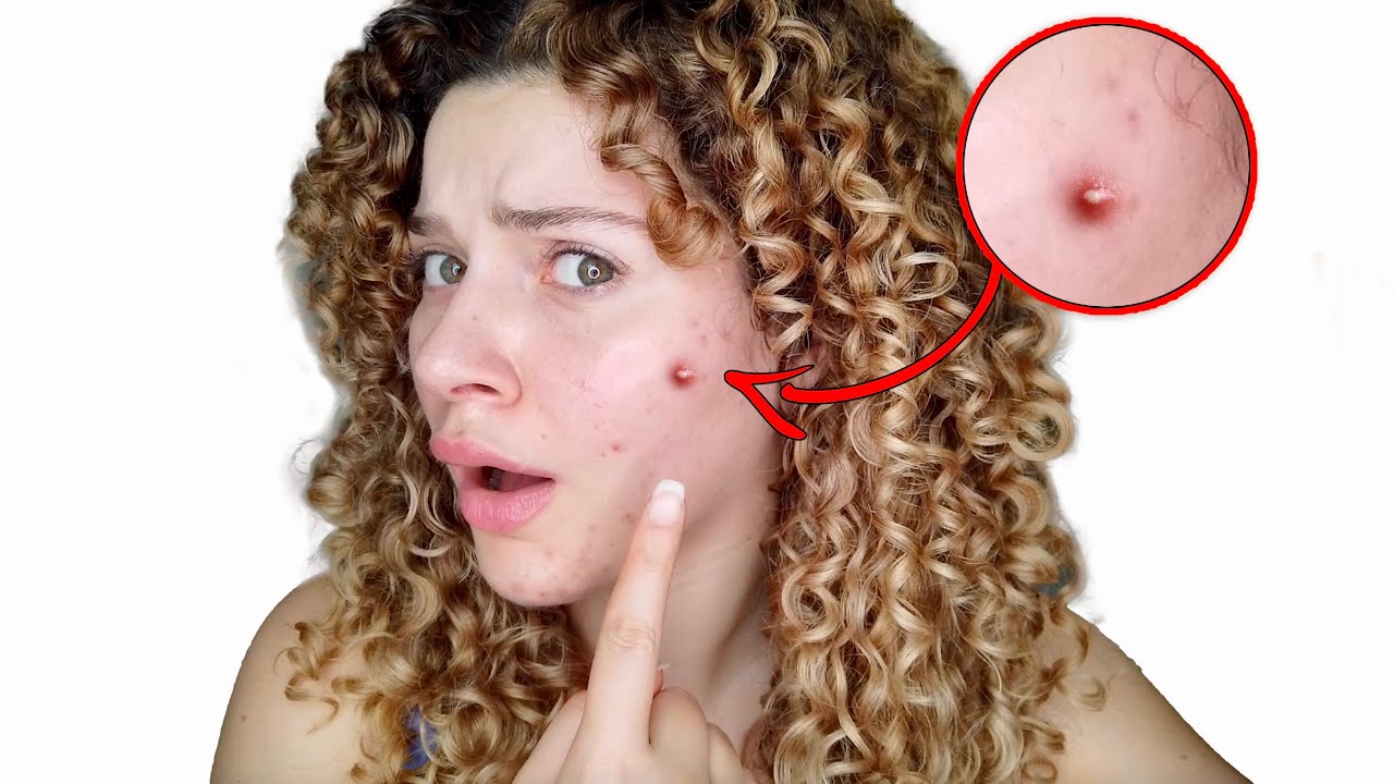 ARE YOUR CURLY HAIR PRODUCTS CAUSING ACNE? (causes, symptoms and solutions)  - YouTube