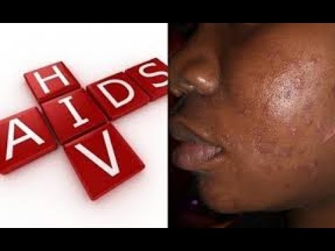 Hiv Symptons