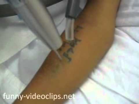 tattoo schnell entfernen youtube tattoo schnell entfernen youtube