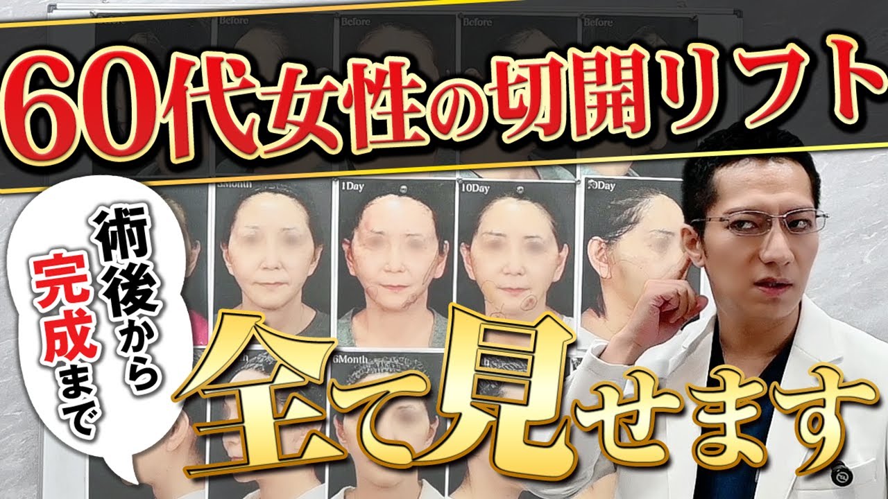 Case study] A complete breakdown of the incision lift procedure