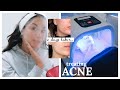 FACIAL PEEL AND AT-HOME FACIAL STEAMING TO HELP ACNE | Beauty&#39;s Big Sister