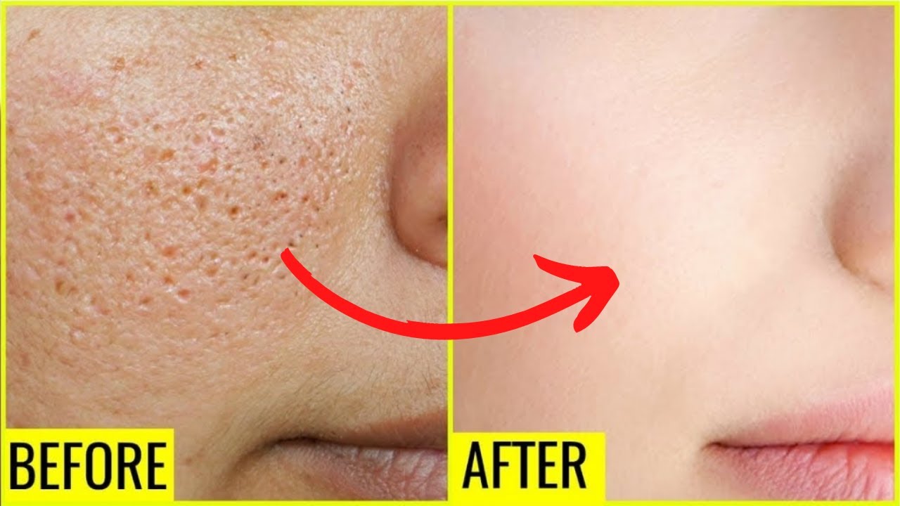 ಹೀಗೆ ಮಾಡಿದರೆ ಮುಖ ರಂದ್ರಗಳು, ಅದರ ಕಲೆಗಳು ಸಂಪೂರ್ಣವಾಗಿ ಮಾಯ । get rid of Open pores and marks at home
