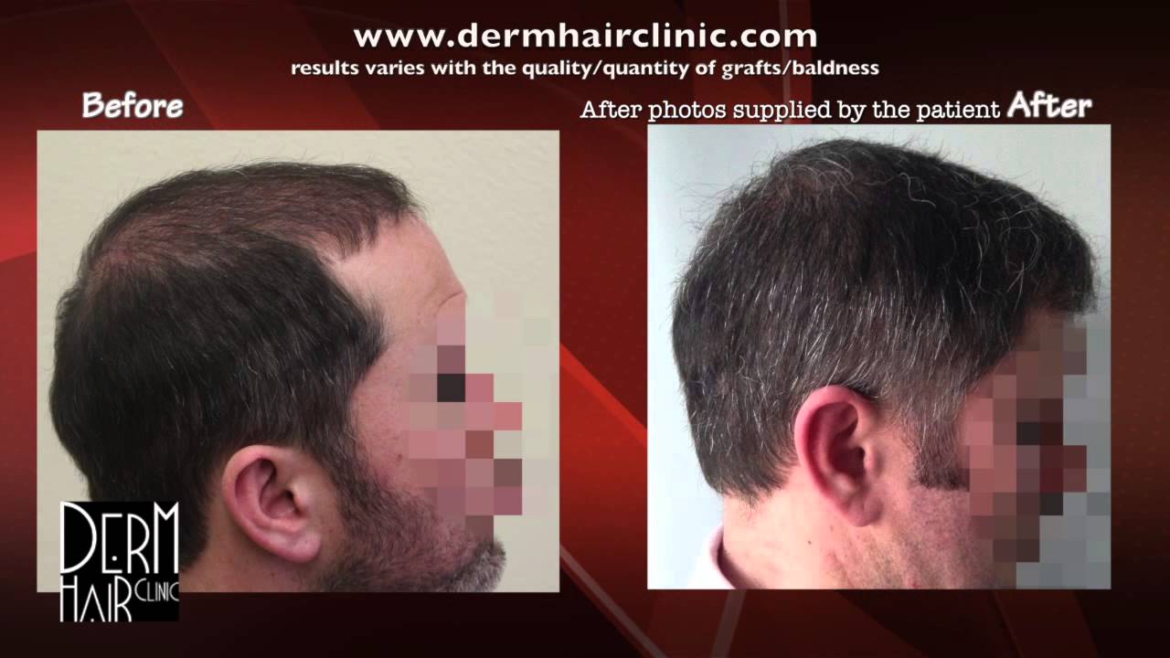 How This Man Got His Hair Back With Dr.U’s  8000 Graft Hair Transplant
