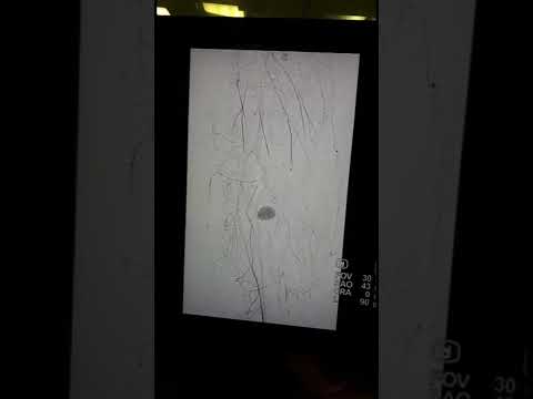 Tratamiento endovascular de