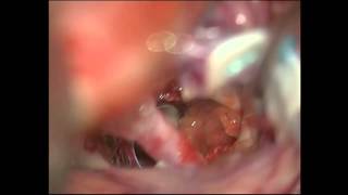 Lesion in posterior clinoid process