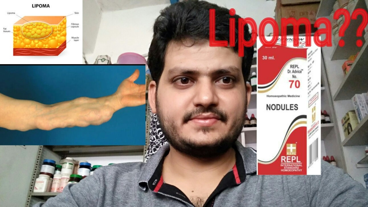 Lipoma Homeopathic Medicine For Lipoma Youtube