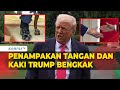 Penampakan Tangan dan Kaki Donald Trump Bengkak, Ini Kata Gedung Putih