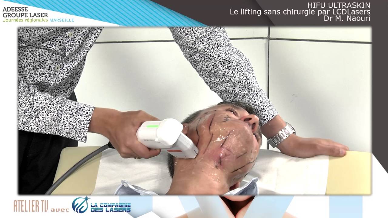 HIFU ULTRASKIN : Le lifting sans chirurgie par LCDLasers.com