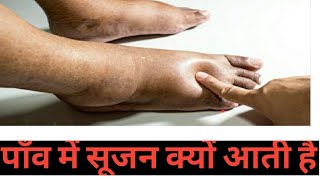 #Ankle and #legswelling in Hindi  ( Ankle में सूजन का इलाज कैसे   complete info )