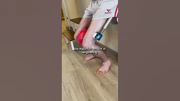 Growing 5 5 CM IN 2 MONTHS With Limb Lengthening Surgery Growtaller 