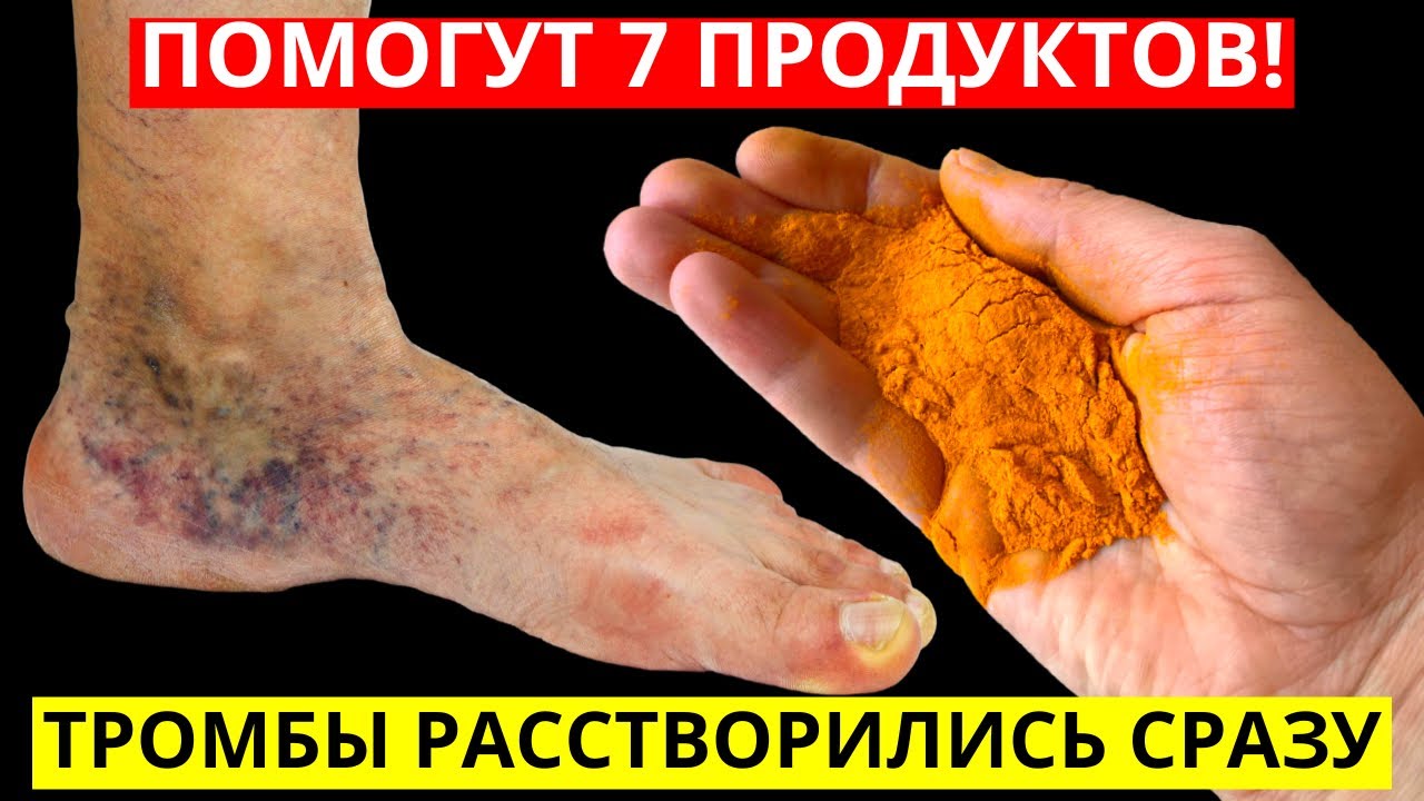 Эти 7 Продуктов Моментально Растворят ТРОМБЫ В Сосудах - YouTube