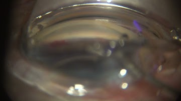 Trabecular microbypass I Stent inject surgery (Glaukos)